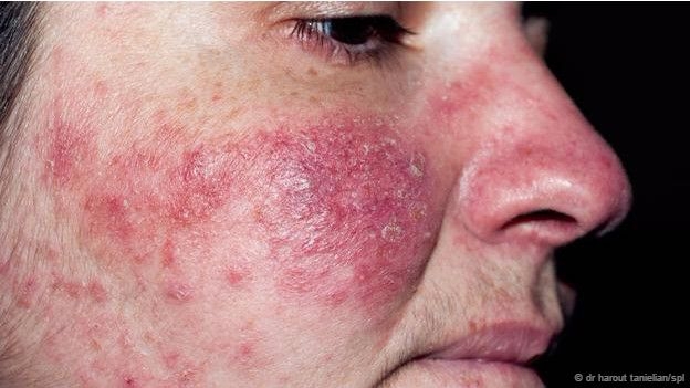 15-05/08/150508141414_rosacea_624x351_bbc_nocredit