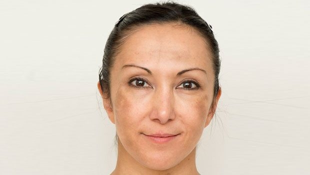 15-05/30/nilufer-atik-yuz-lekesi-sari-kantaron