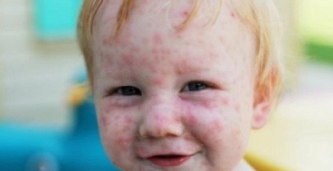 18-12/09/kelebek-hastaligi-nedir-nasil-tedavi-edilir