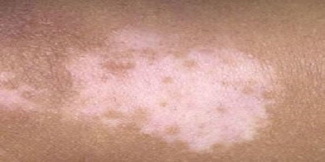 19-12/11/vitiligo-2.jpg