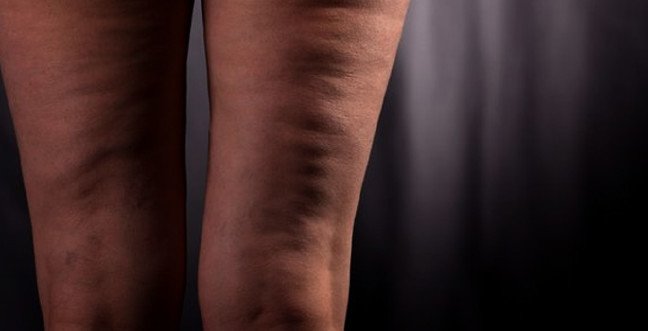 19-12/13/selulitjpgg-1576229217