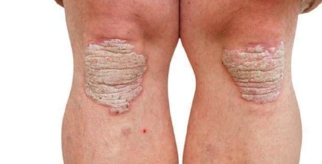 19-12/26/sedef-hastaligi