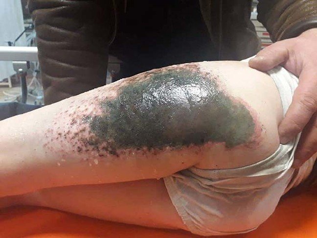 20-01/18/karla-oynarken-vucutlarinda-yanik-olusan-2-cocuga-doku-nakli-yapilacak_1903_dhaphoto2-1