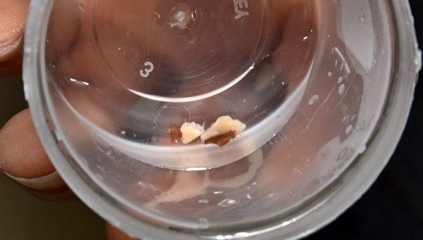 20-02/02/zaturre-teshisi-konulan-cocugun-akcigerinden-badem-cikti_3748_dhaphoto5